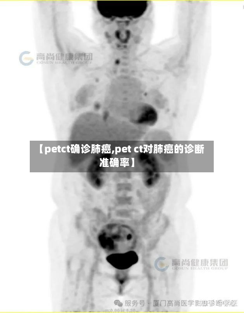 【petct确诊肺癌,pet ct对肺癌的诊断准确率】